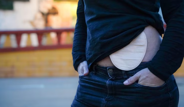 How to Change an Ostomy Bag: A Step-by-Step Guide for Beginners