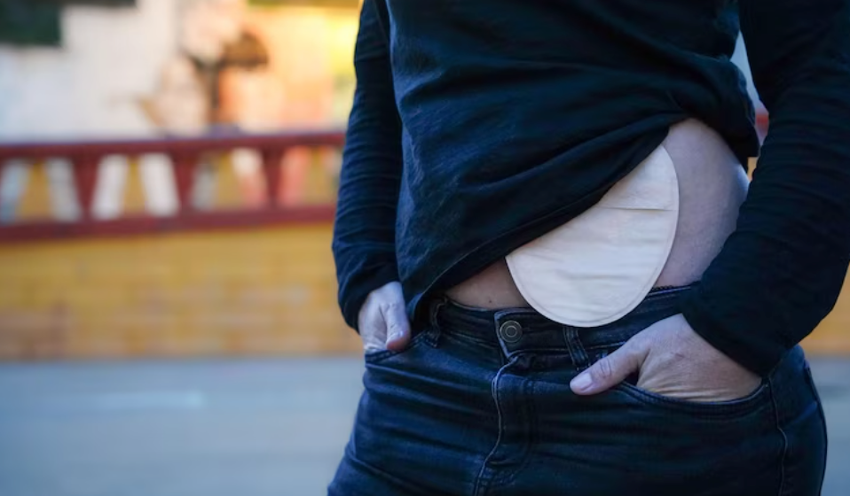 How to Change an Ostomy Bag: A Step-by-Step Guide for Beginners